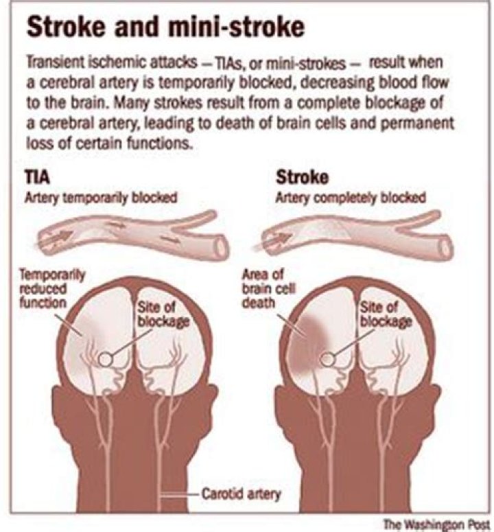 Difference Between Stroke and TIA Signs and Symptoms, Causes, Risk
